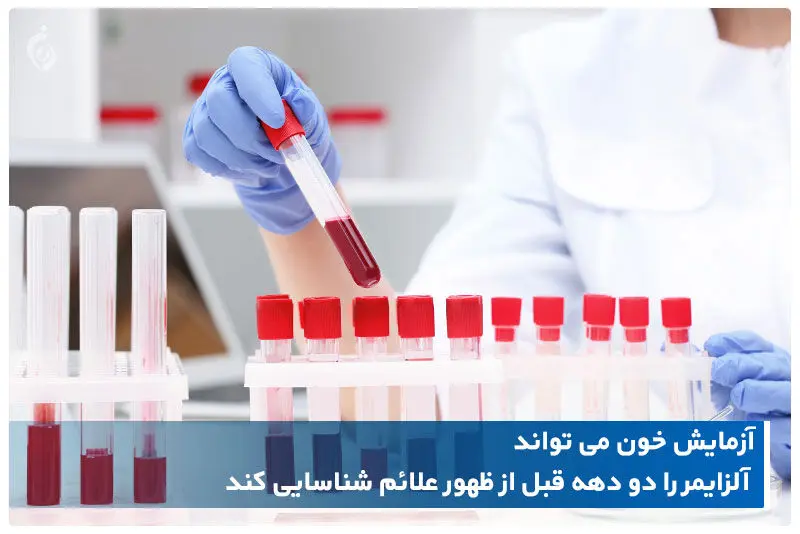 تشخیص آلزایمر و میزان پیشرفت آن با آزمایش خون