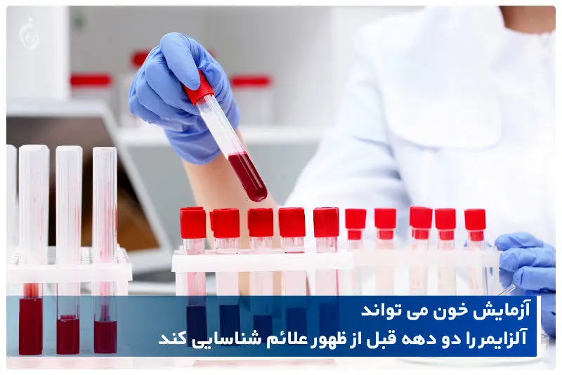 تشخیص آلزایمر و میزان پیشرفت آن با آزمایش خون