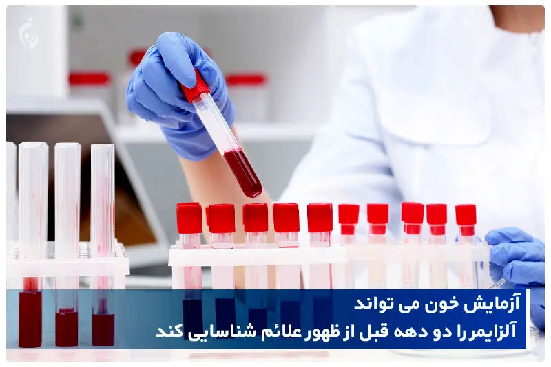 تشخیص آلزایمر و میزان پیشرفت آن با آزمایش خون