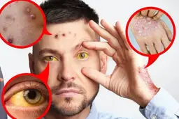 این هشت نشانه یعنی شما به کبد چرب مبتلا هستید 