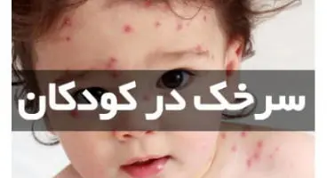 شیوع بیماری سرخک در کشور / واکسیناسیون کودکان را جدی بگیرید