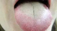 سفید شدن روی زبان خطرناک است؟