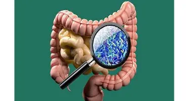 تاثیر عجیب میکروب های روده بر شدت سکته مغزی