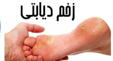 رژیم غذایی مناسب،بهترین راه برای درمان زخم دیابتی