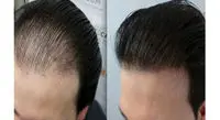 ترفندی که میتوانید با آن همه ی موهای ریخته شده خود را برگردانید