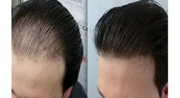 ترفندی که میتوانید با آن همه ی موهای ریخته شده خود را برگردانید