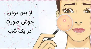 عوامل ایجاد جوش صورت/ یک شبه جای جوش را درمان کنید