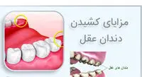 خطرات نکشیدن دندان عقل که از آن بی اطلاعید
