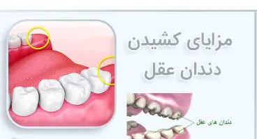 خطرات نکشیدن دندان عقل که از آن بی اطلاعید
