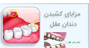 خطرات نکشیدن دندان عقل که از آن بی اطلاعید