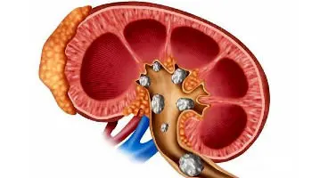 علل سنگ سازی کلیه چیست؟