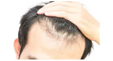 چه عواملی بر ریزش مو تاثیرگذار است؟