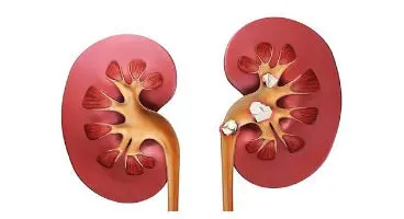 برای پیشگیری از عود سنگ کلیه چه کنیم؟