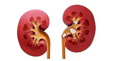 برای پیشگیری از عود سنگ کلیه چه کنیم؟
