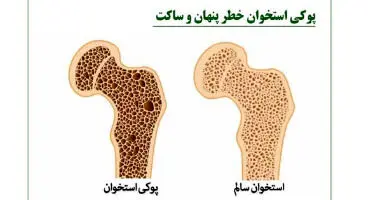 از بیماری خاموش پوکی استخوان چه می‌دانید؟