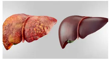 نسخه طب سنتی برای کبد چرب