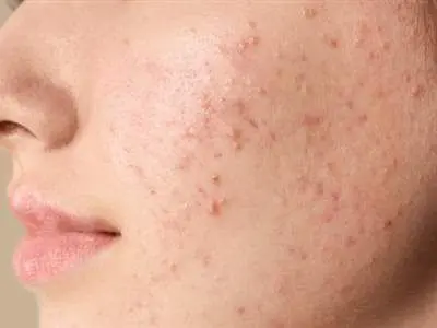 علت جوش زدن صورت و راه های در مان آن