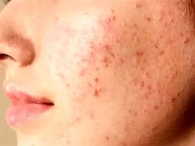علت جوش زدن صورت و راه های در مان آن
