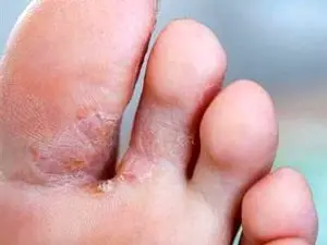 پا در هر کفشی نکنید/ عفونت های قارچی پا و روش درمان آنها