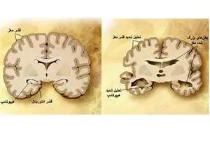 تفاوت آلزایمر با زوال عقل چیست؟