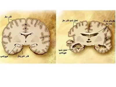 تفاوت آلزایمر با زوال عقل چیست؟