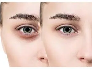 با انواع سیاهی زیر چشم و راه های رفع هر یک آشنا شوید