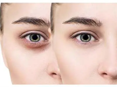 با انواع سیاهی زیر چشم و راه های رفع هر یک آشنا شوید