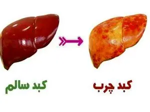 علائم ابتلا و روش درمان کبد چرب چیست؟