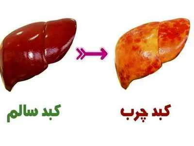 علائم ابتلا و روش درمان کبد چرب چیست؟