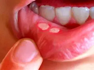 چگونه "آفْت دهان" خود را با چند راهکار طب سنتی درمان کنیم؟
