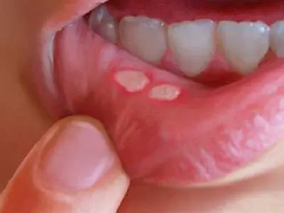 چگونه "آفْت دهان" خود را با چند راهکار طب سنتی درمان کنیم؟