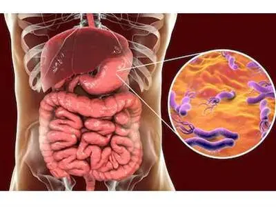 علائم میکروب معده+اینفوگرافی