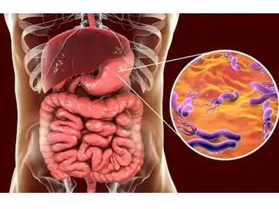 علائم میکروب معده+اینفوگرافی