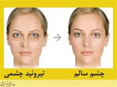 آنچه باید در مورد علائم تیروئید چشمی و راه حل آن بدانید!