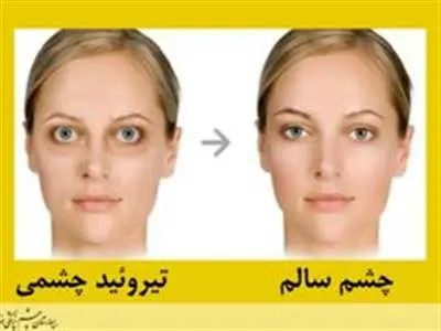 آنچه باید در مورد علائم تیروئید چشمی و راه حل آن بدانید!