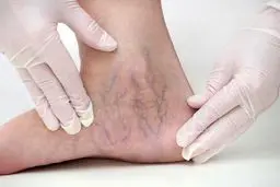 این علائم در پا می‌تواند نشانه‌ ای از بیماری واریس باشد
