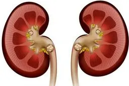 علائم، درمان و باورهای غلط درباره سنگ کلیه