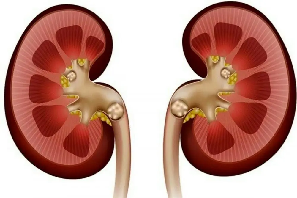 علائم، درمان و باورهای غلط درباره سنگ کلیه