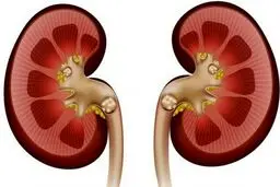 علائم، درمان و باورهای غلط درباره سنگ کلیه