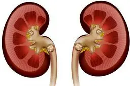 علائم، درمان و باورهای غلط درباره سنگ کلیه
