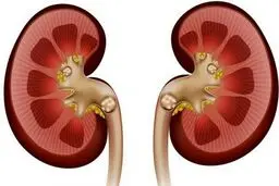 علائم، درمان و باورهای غلط درباره سنگ کلیه