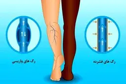 پیشگیری از واریس با چند عادت ساده