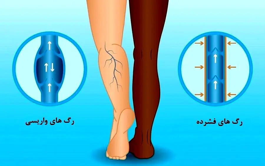 پیشگیری از واریس با چند عادت ساده