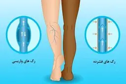 پیشگیری از واریس با چند عادت ساده