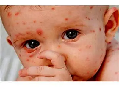آنفولانزا، آبله مرغان و سرخک تا چند روز احتمال سرایت دارد؟