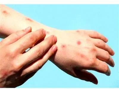 هشدار؛ آبله میمونی در کمین است