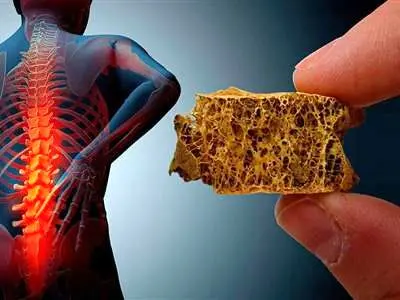 3نشانه اولیه شروع پوکی استخوان