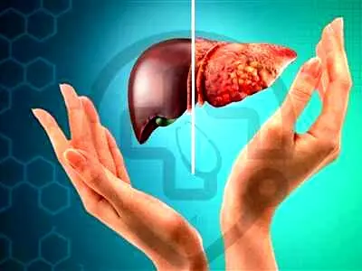 ۱۰ علامت و نشانه‌ ابتلا به کبد چرب