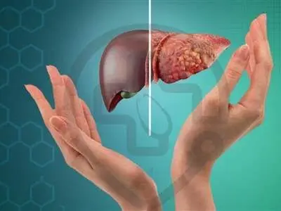 ۱۰ علامت و نشانه‌ ابتلا به کبد چرب