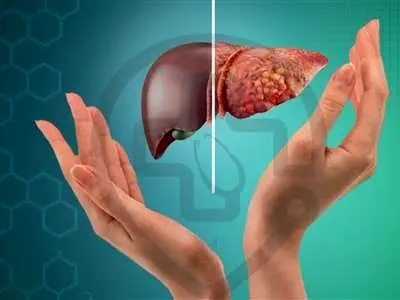 ۱۰ علامت و نشانه‌ ابتلا به کبد چرب